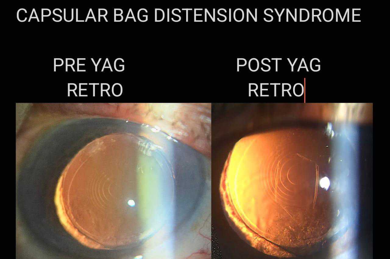 Capsular Bag Distension