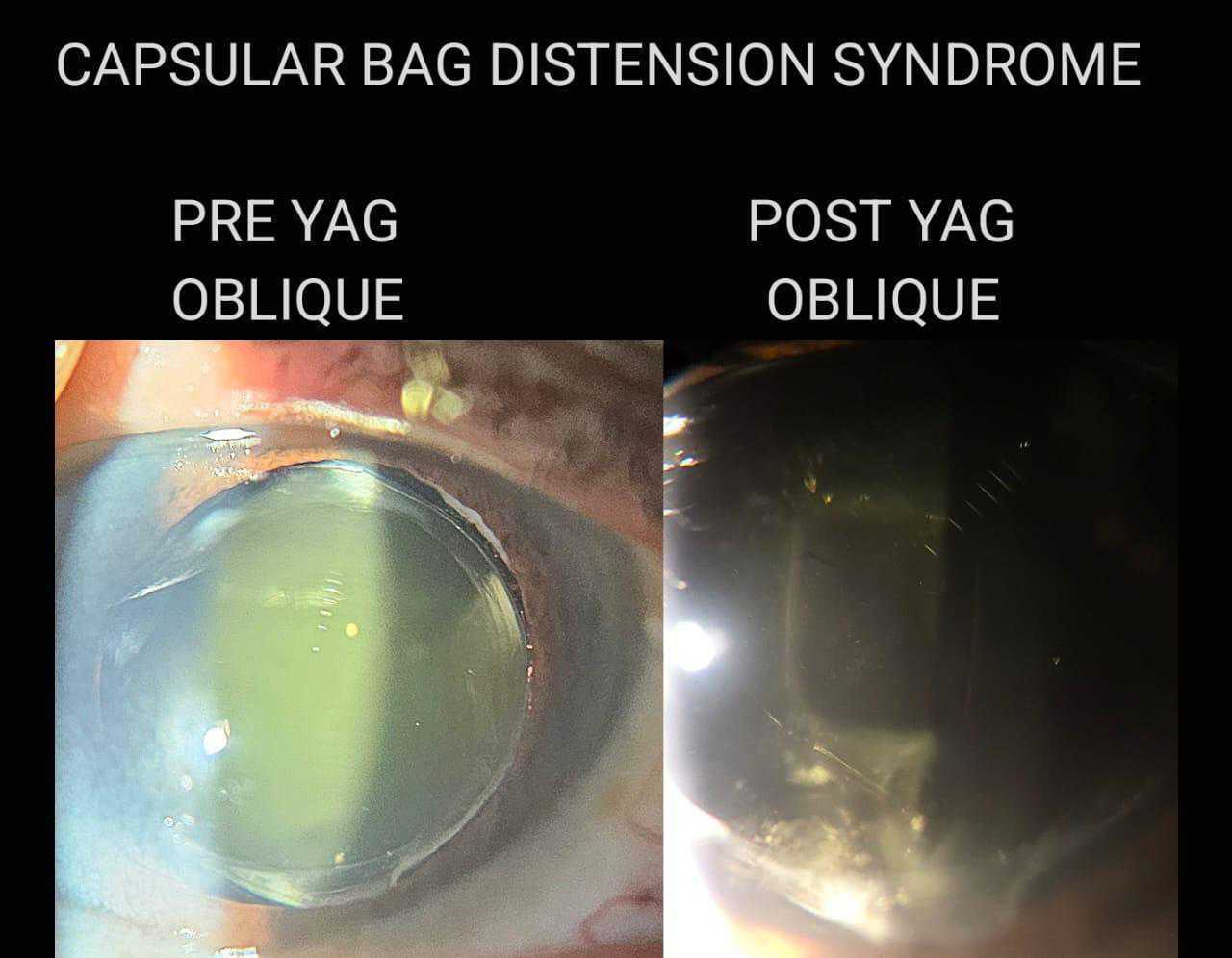 Capsular Bag Distension