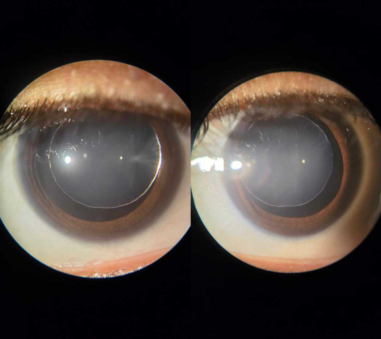 Cataract
